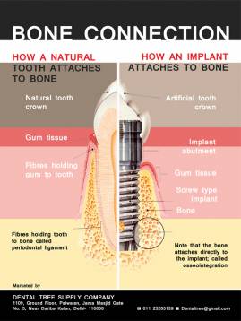 Implant poster